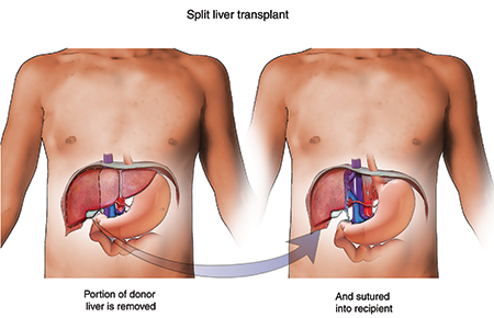 Image result for Deceased Liver transplant