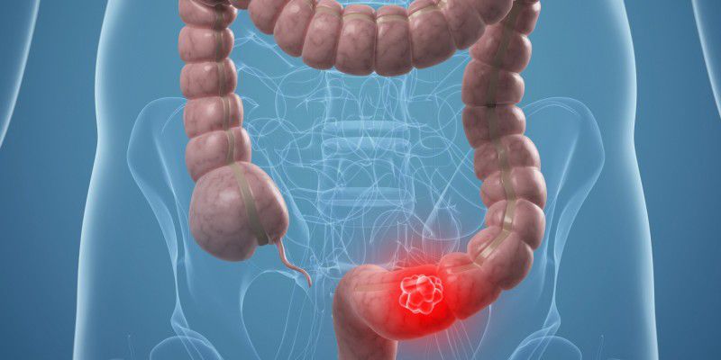Colorectal Cancer Rises Among Younger Adults: Expectations vs. Reality