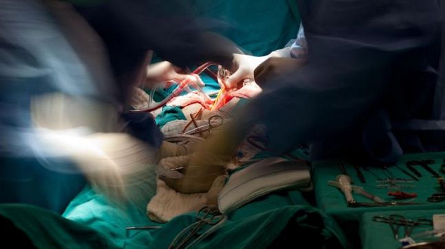 Image result for liver transplant surgery