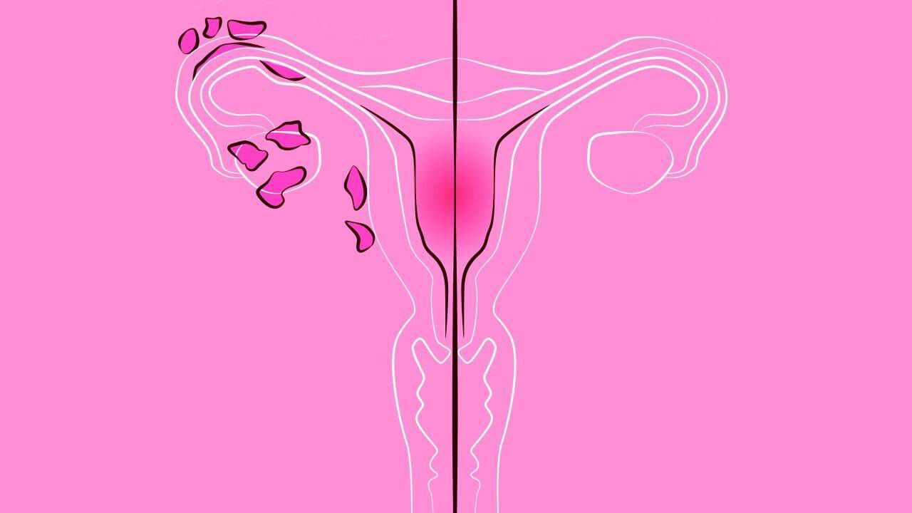 Warum Endometriose so selten diagnostiziert wird