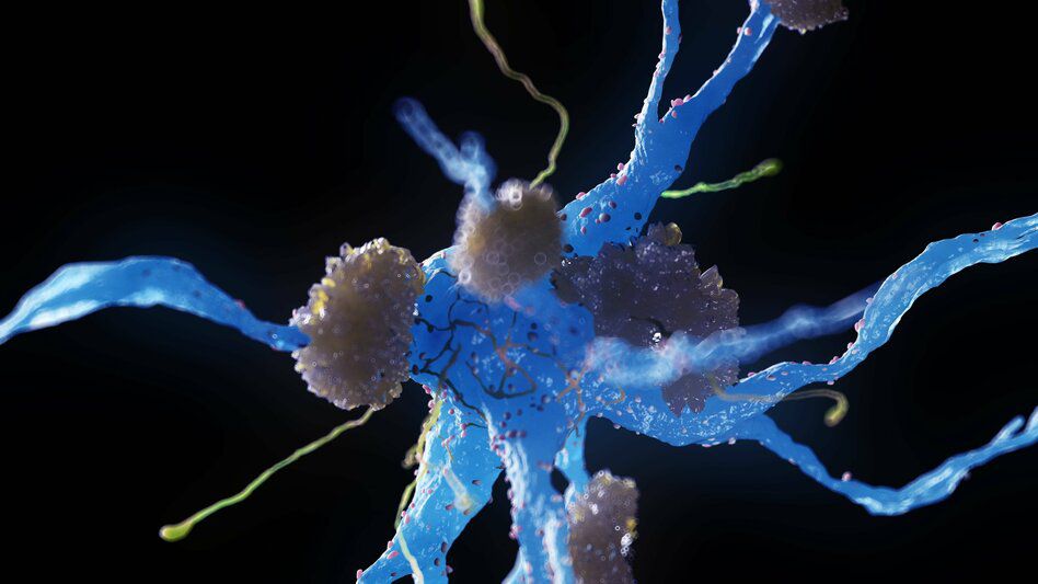 Neurologe über Alzheimer und Downsyndrom: „Die Krankheit planbar machen"