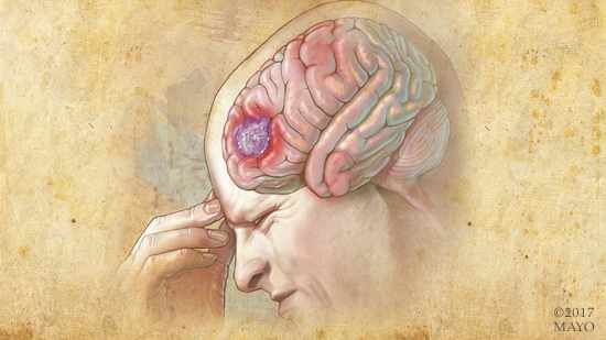 Brain Tumor: Symptoms, Diagnosis & Treatment