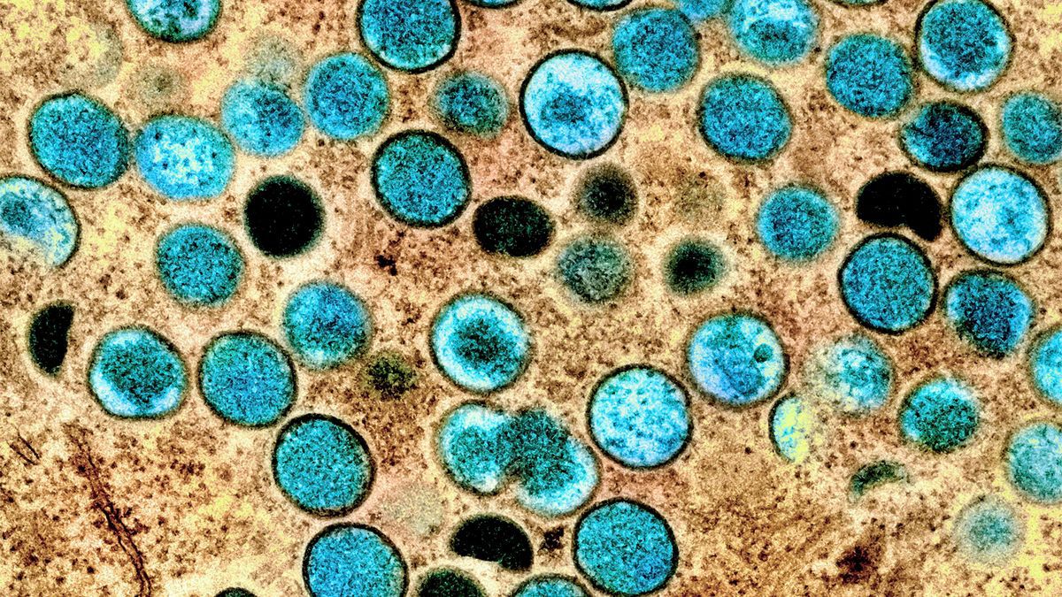 Mpox-Virus: Das lief seit den ersten Fällen schief