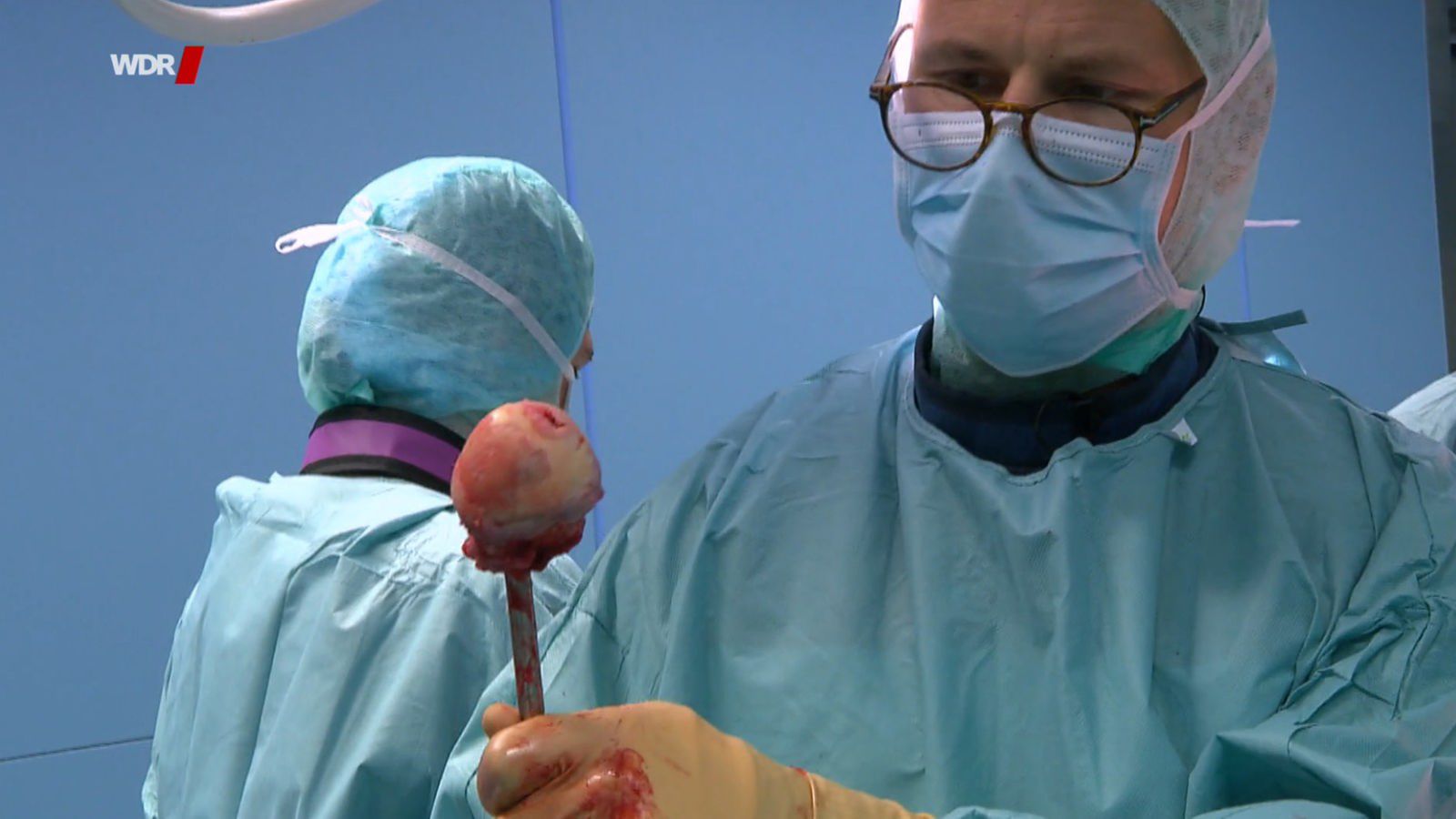 Transplantation von Knochenteilen