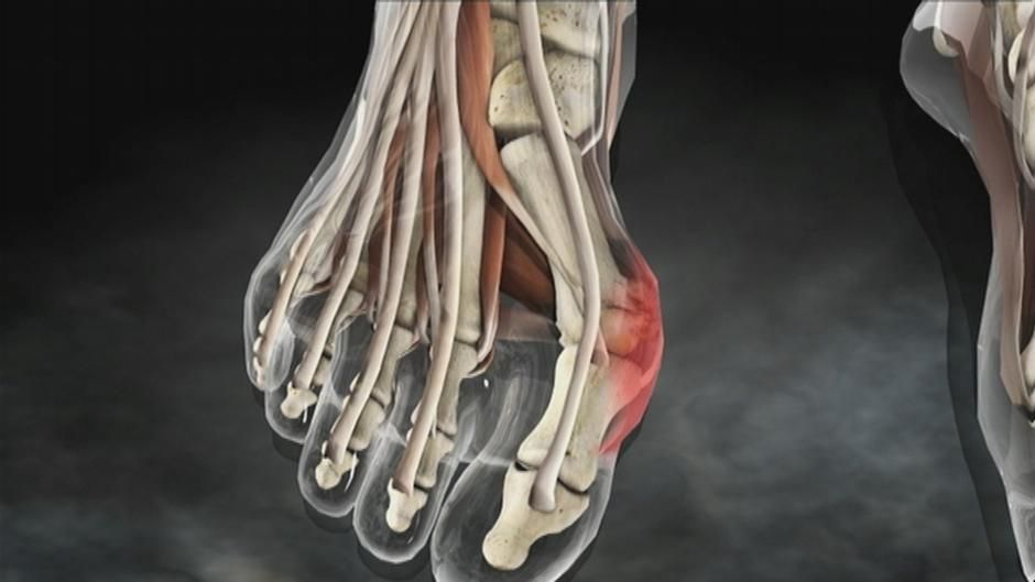 Deutsche Welle TV: Quicker cure: Hallux Valgus