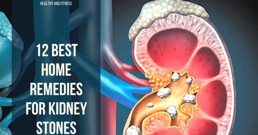 12 BEST HOME REMEDIES FOR KIDNEY STONES